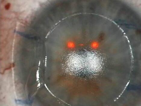 ĤͼָĸԻĤɽɽĤĤPRKƤ׼ӼĤ(Trans-PRK)Ҵ׼ӼƤ½Ĥĥ(LASEK);ҲɽɽĤLASIK뼤⸨LASIK2.jpg